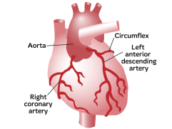 Coronary Artery Disease